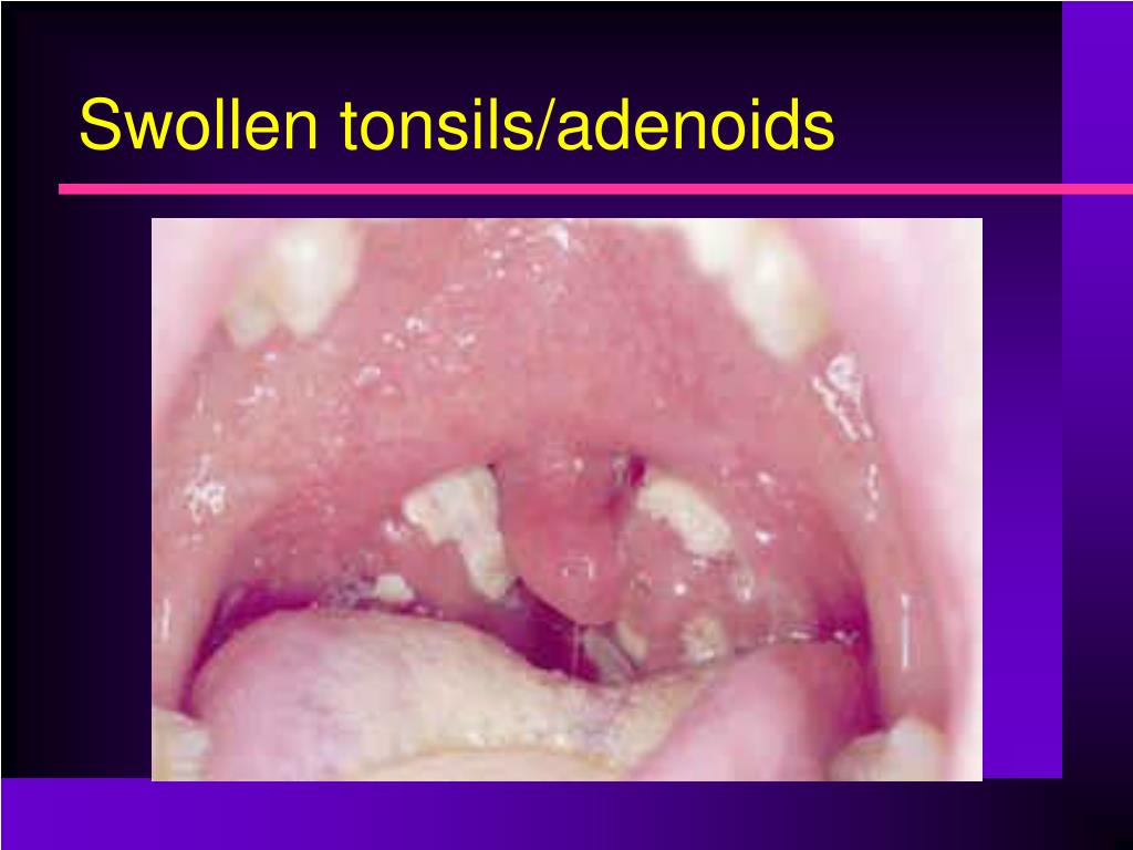 Adenoids And Tonsils