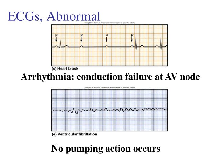 PPT - Electrocardiography – Abnormalities (Arrhythmias) 7 PowerPoint ...