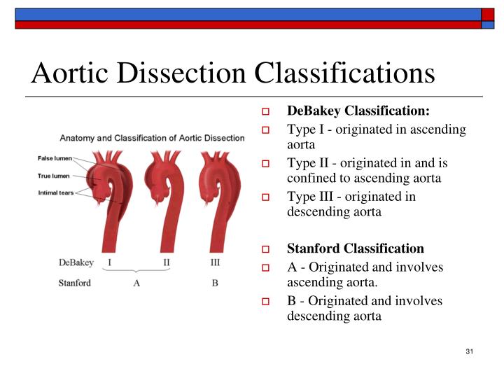 Classification Of Aortic Dissection