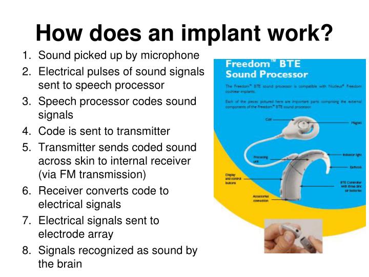 PPT Cochlear Implants PowerPoint Presentation ID 4342251