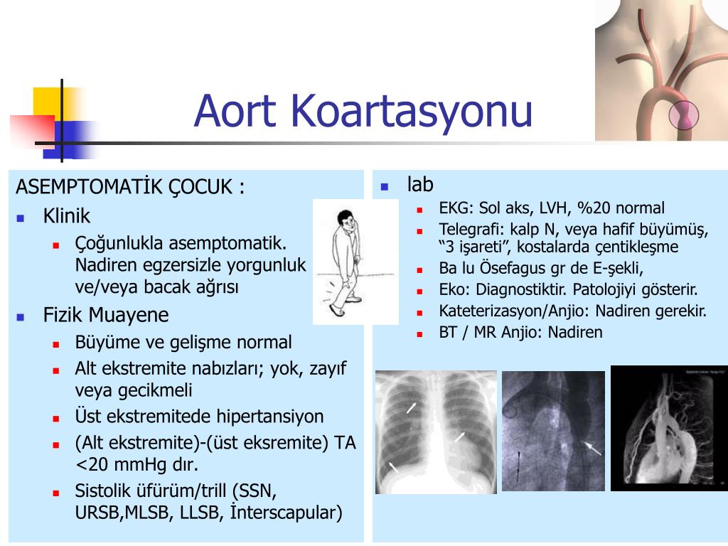 PPT - Aort Koarktasyonu, Aortik İnterruption ve Arkus Aorta Anomalileri  (Vasküler Ring) PowerPoint Presentation - ID:4343400