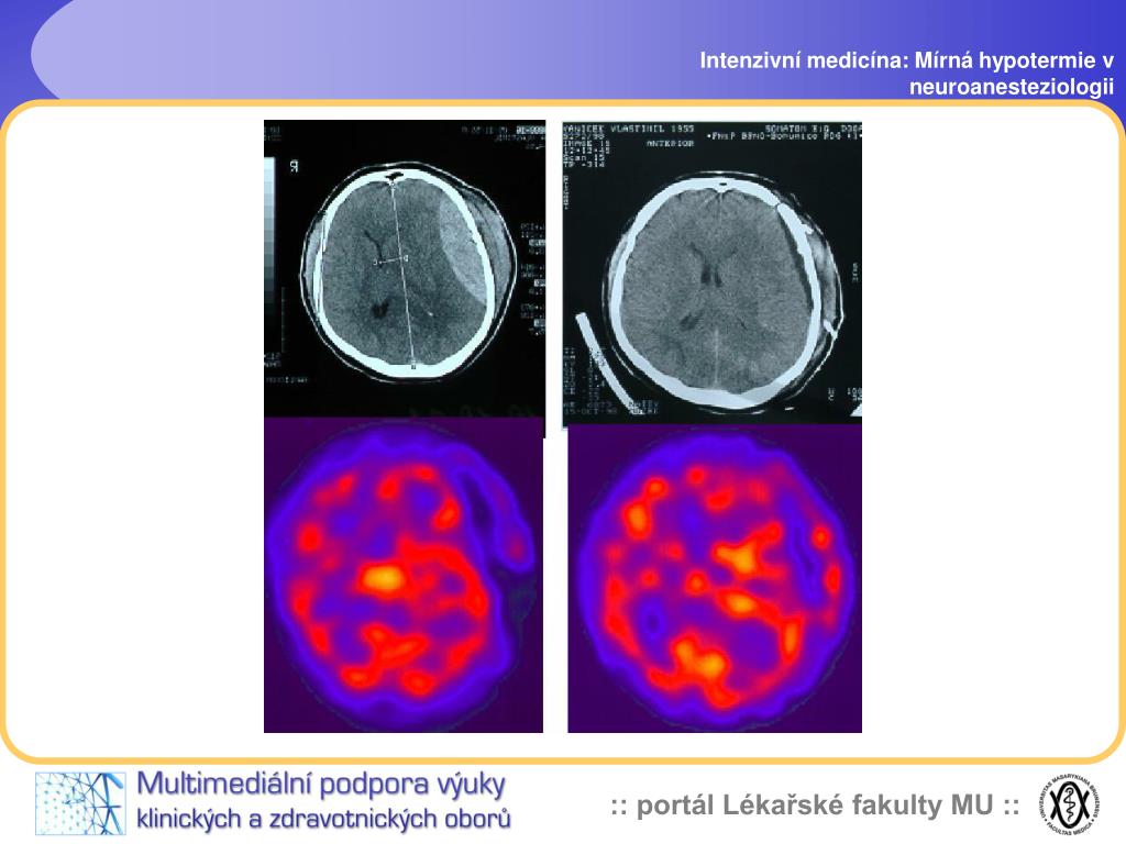 PPT - Mírná hypotermie v neuroanesteziologii a neurointenzivní péči  PowerPoint Presentation - ID:4350651