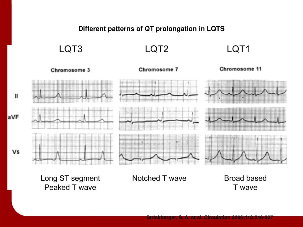 Удлинение интервала qt. Врожденный синдром удлиненного интервала qt. Синдром удлиненного интервала qt 2 Тип. Укороченный интервал qt на ЭКГ. Синдром удлиненного интервала qt ЭКГ снимок.