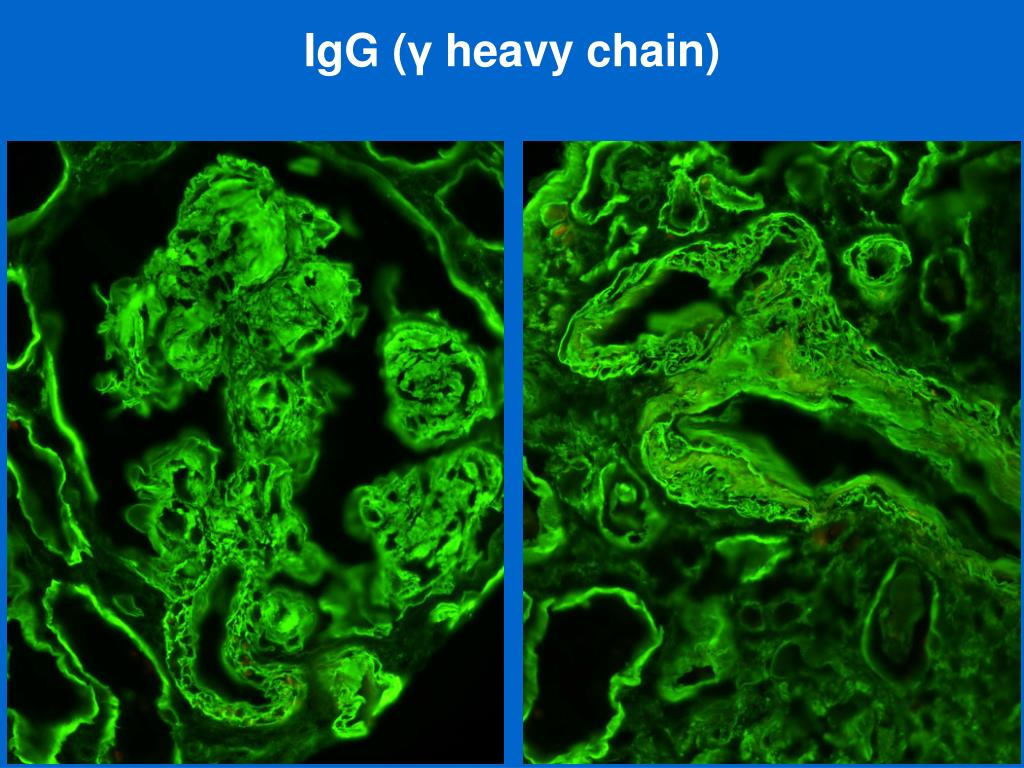 PPT Heavy chain deposition disease in kidney biopsies PowerPoint