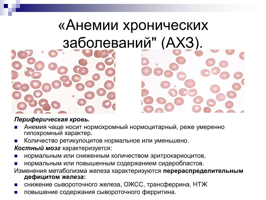 Малокровие вызвано. Показатели крови при анемии хронических заболеваний. Анемия хрон заболеваний. Анемия хронических заболеваний картина крови. Анемия хронических заболеваний характеристика.