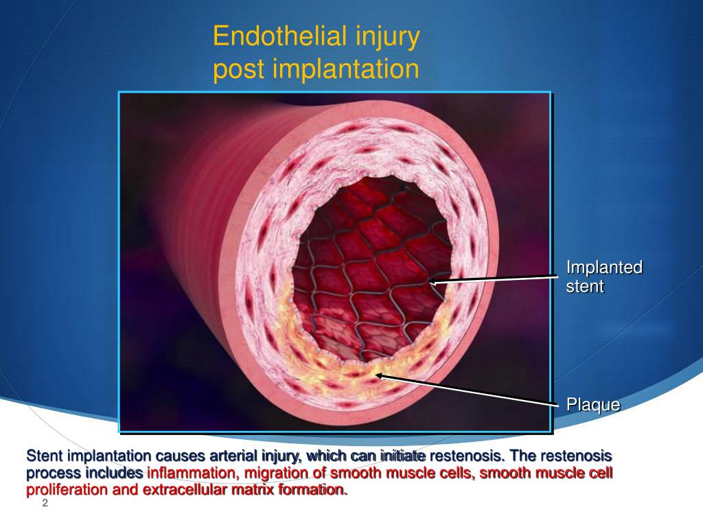 eluting drug stents ppt stent implantation powerpoint presentation