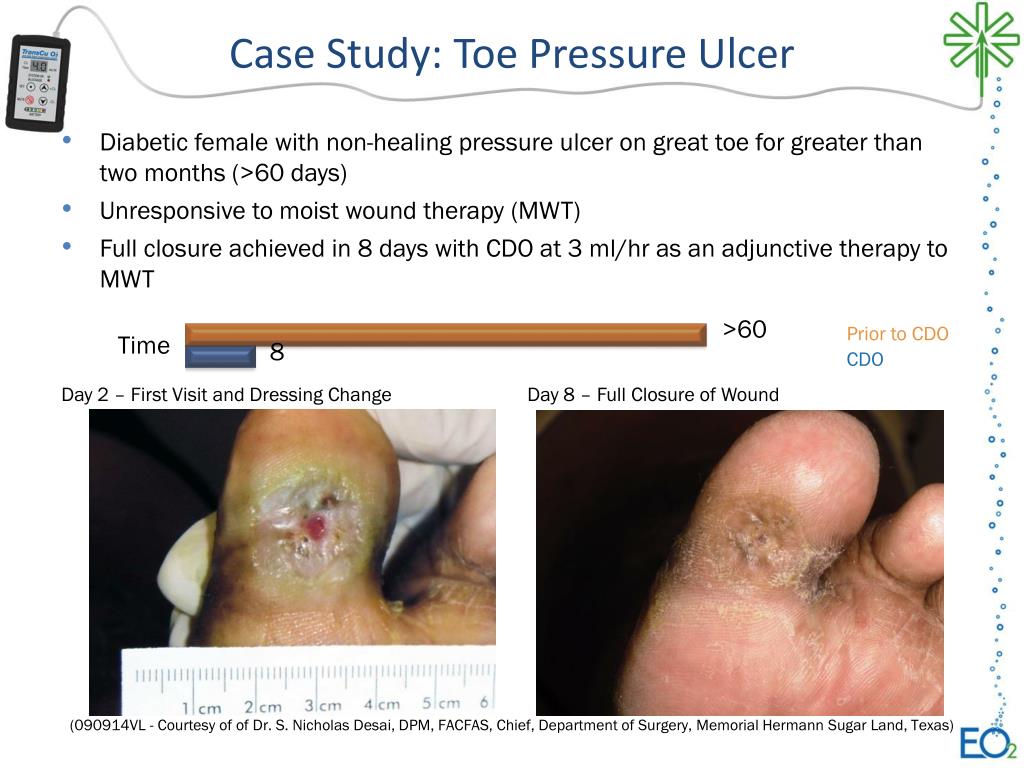sample case study of pressure ulcer