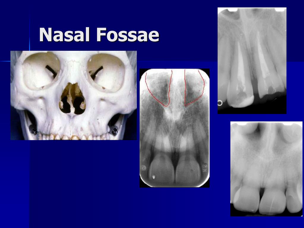 Nasal Fossa X Ray