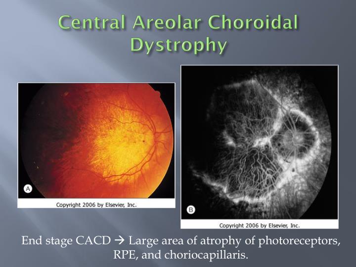 Ppt Hereditary Choroidal Disease Powerpoint Presentation Id 4411245