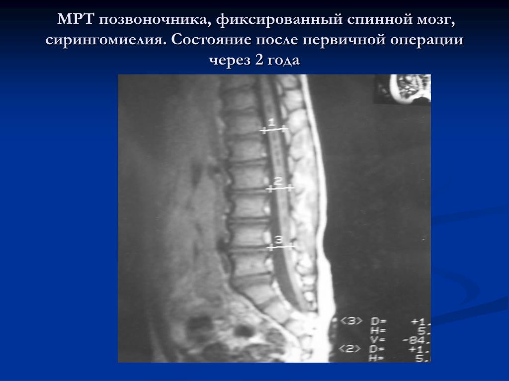 Фиксированный спинной. Синдром фиксации спинного мозга. Фиксированный спинной мозг мрт медунивер. Фиксация терминальной нити спинного мозга. Синдром фиксированного спинного мозга у детей.