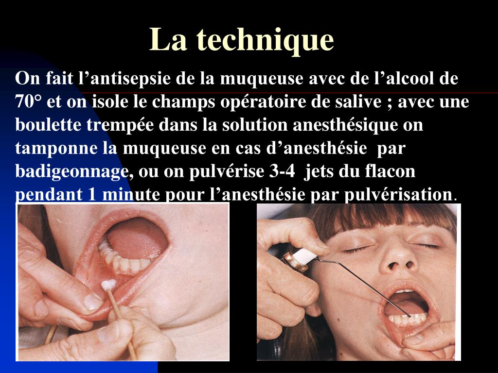 Qu'est-ce que l'anesthésie de la langue