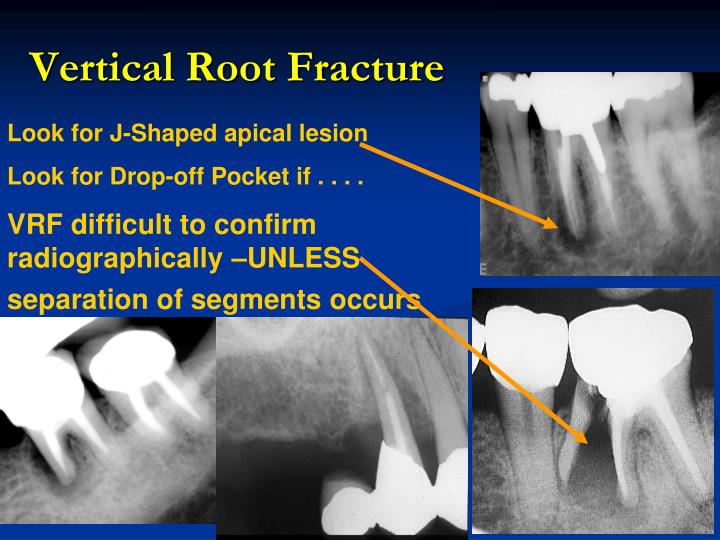 PPT D435 Endodontics I PowerPoint Presentation ID4443713
