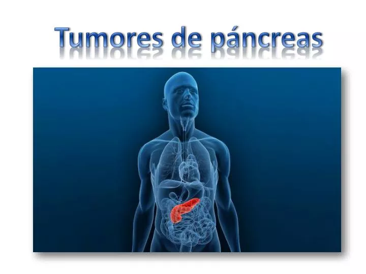tumores de p ncreas n.