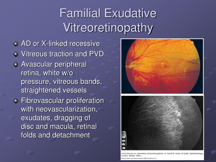 Ppt Vitreous And Retina Pediatric Ophthalmology Powerpoint
