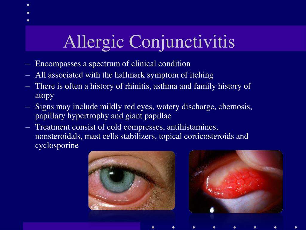 allergic conjunctivitis cold compress allergic conjunctivitis cold compress