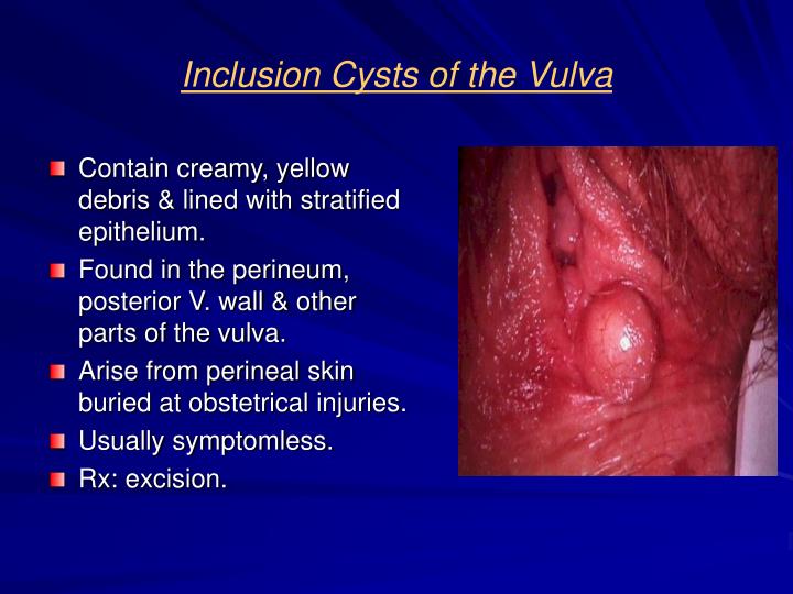 Lesions vagina vulva words Cannot be! Lesions vagina vulva