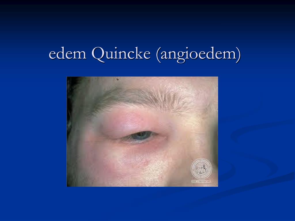 edem de quincke edem de quincke