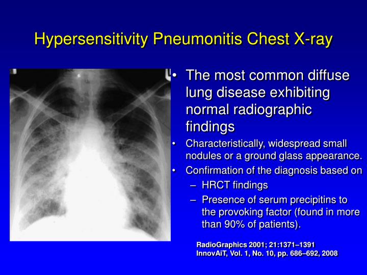 PPT Pneumoconiosis PowerPoint Presentation ID4489834