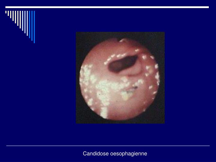PPT - DYSPHAGIE PowerPoint Presentation - ID:4491266