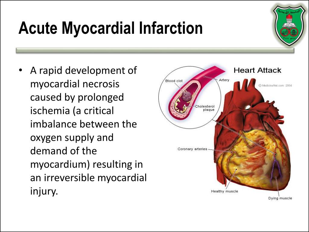 presentation of myocardial infarction