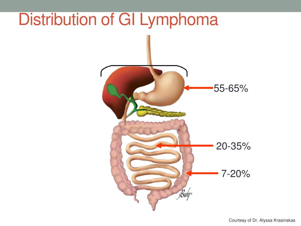 Ppt Gastrointestinal Malt Lymphoma Powerpoint Presentation Free