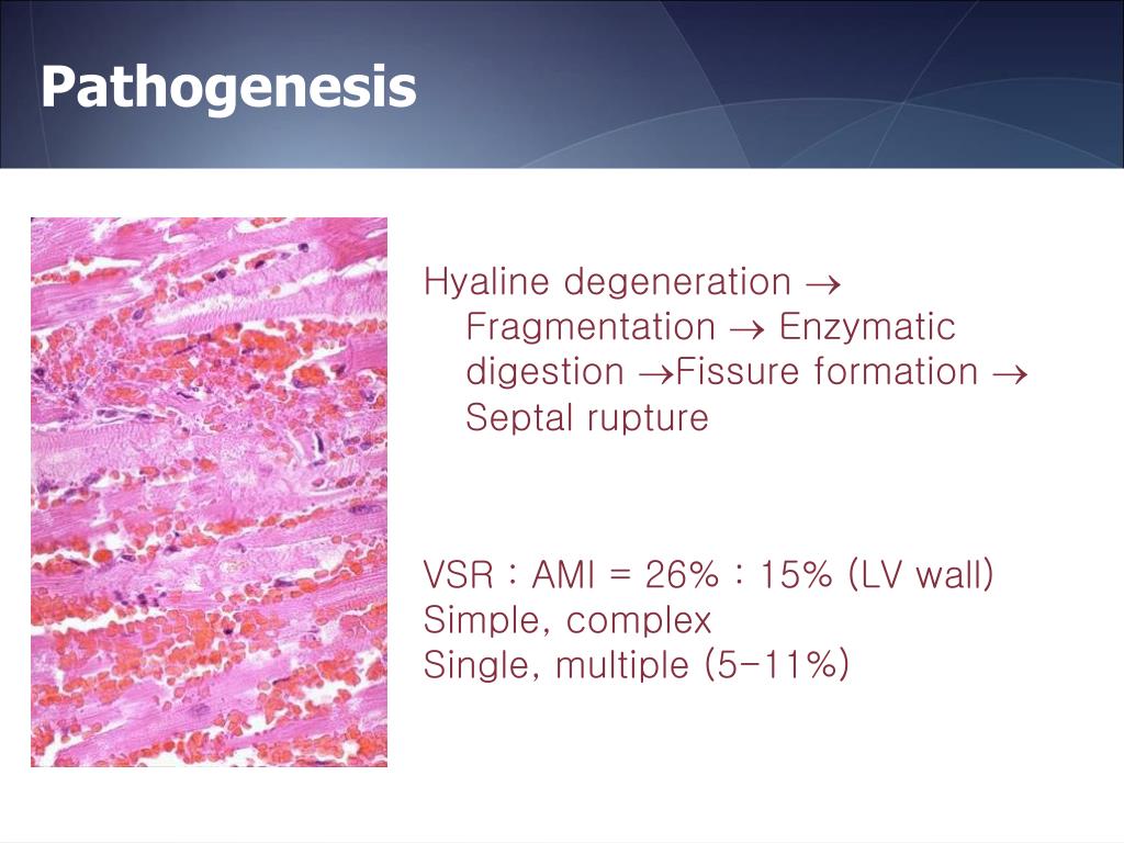 PPT Post infarction Ventricular Septal Rupture and Free Wall Rupture PPT Post infarction Ventricular Septal Rupture and Free Wall Rupture
