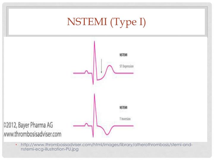 what-is-a-nstemi-type-2-slide-share