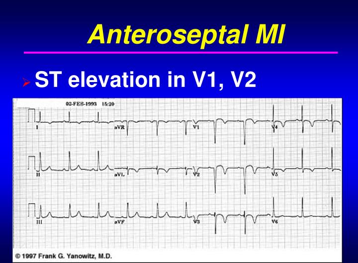 PPT AMI/ACS Diagnosis History and Physical PowerPoint Presentation