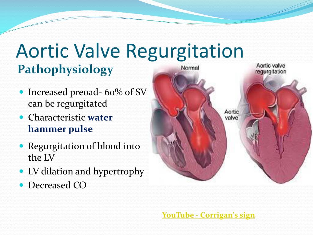 Dissertation on aortic regurgitation