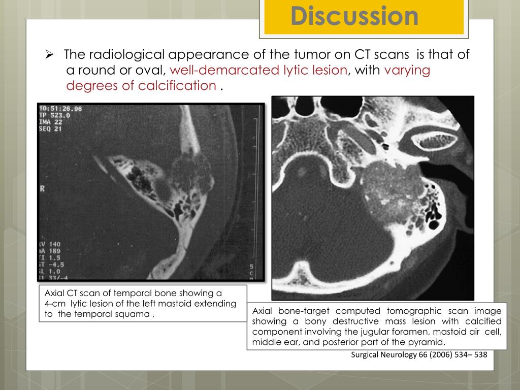 PPT - BENIGN OSTEOBLASTOMA IN AN UNUSUAL MASTOID LOCATION PowerPoint ...