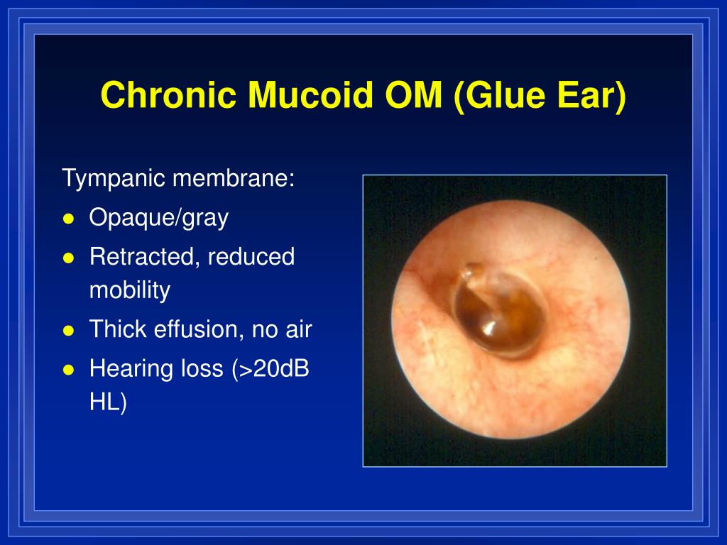 Ppt Otitis Media And Eustachian Tube Dysfunction Powerpoint