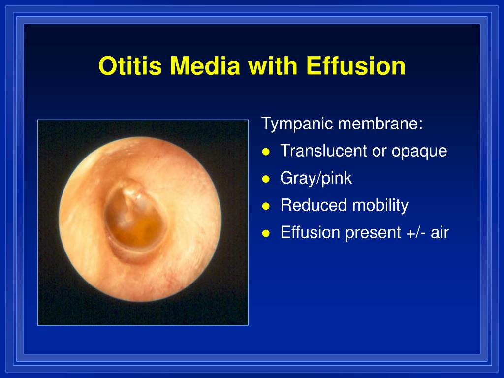 Otitis Media Effusion