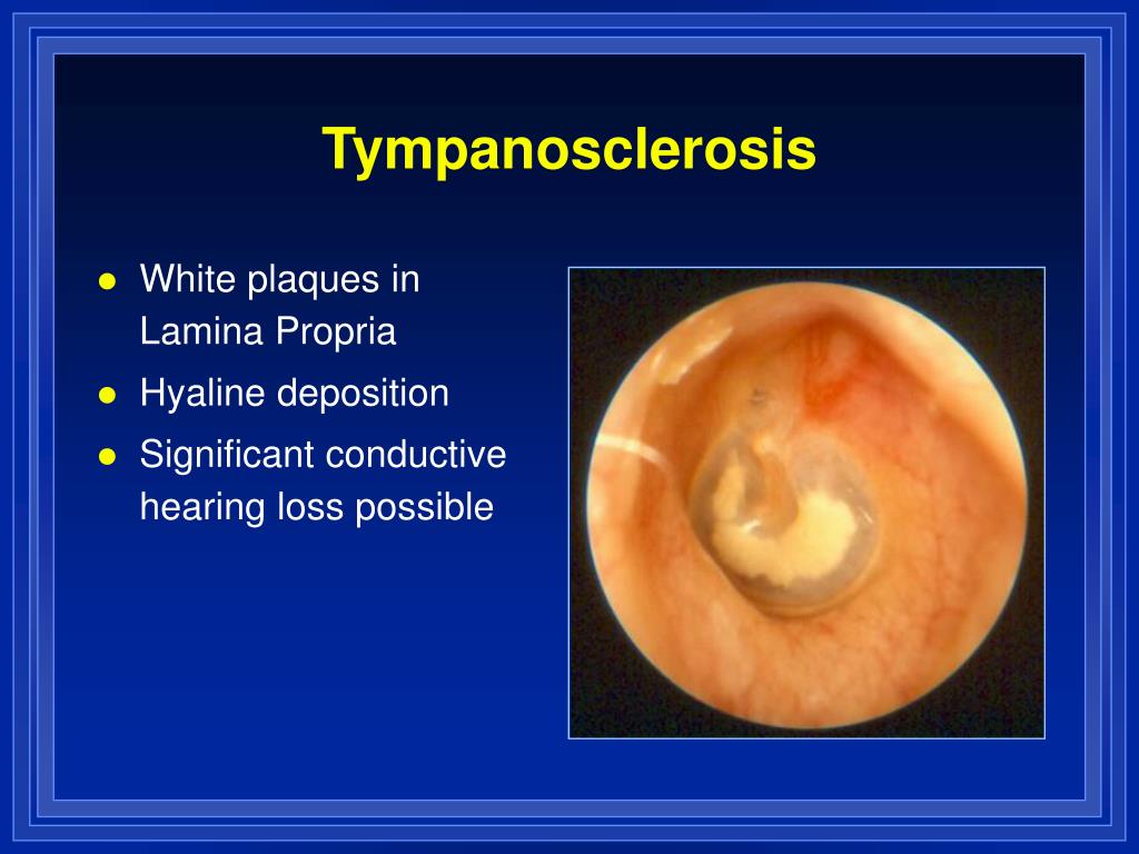 PPT Otitis Media and Eustachian Tube Dysfunction PowerPoint Presentation ID4502218
