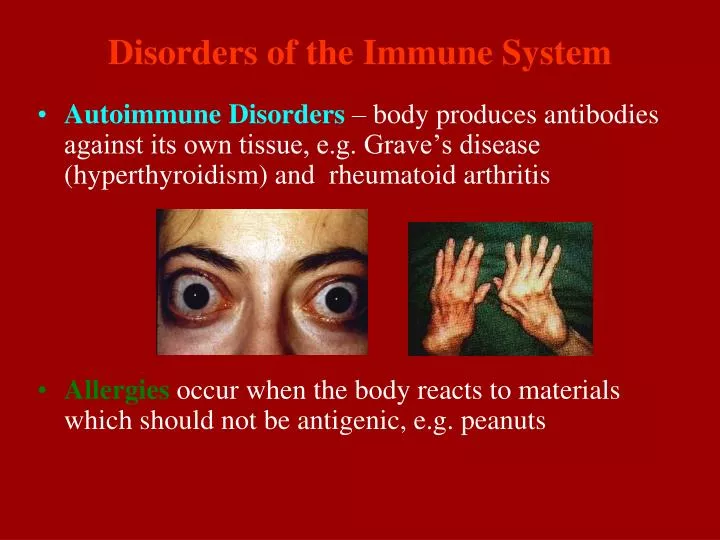 an overview of the defect of the immune system graves disease What are autoimmune diseases an autoimmune disease occurs when the immune system confuses your own body for a hashimoto's disease affects the thyroid. an overview of the defect of the immune system graves disease What are autoimmune diseases an autoimmune disease occurs when the immune system confuses your own body for a hashimoto's disease affects the thyroid.