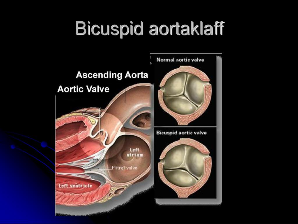 PPT Aortastenose Og Mitralstenose PowerPoint Presentation Free 