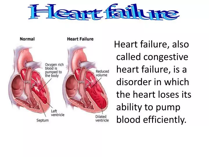 atypical presentation of heart failure