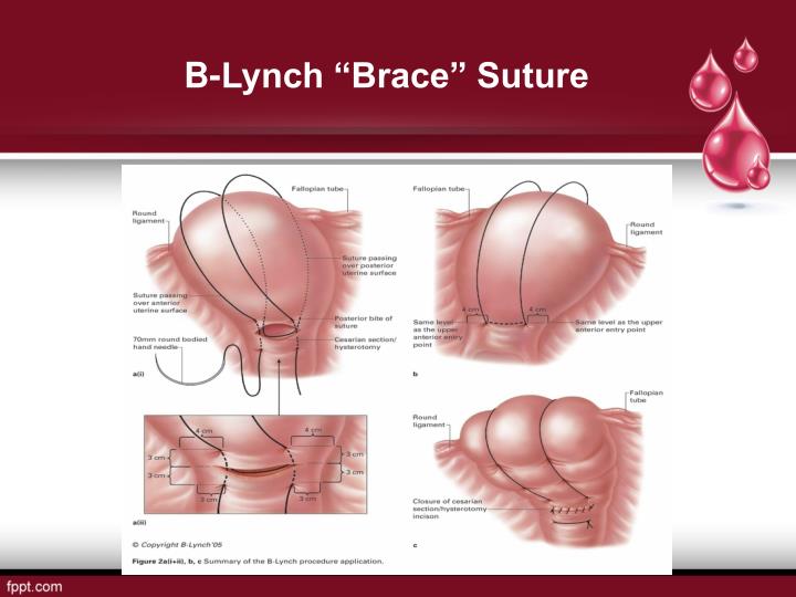 PPT - MANAGEMENT OF POST PARTUM HAEMORRHAGE DRILL PowerPoint ...