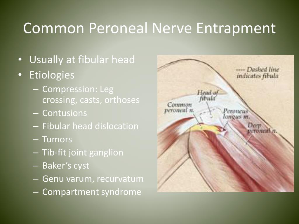 PPT Nerve Entrapments In Runners PowerPoint Presentation Free 