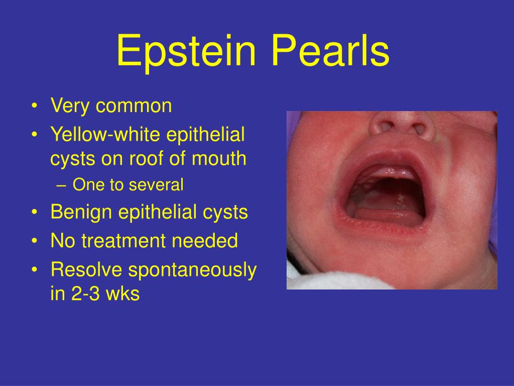 Epstein Pearls