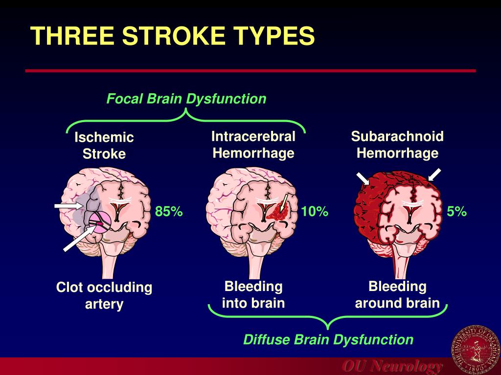 Ppt Update In Acute Ischemic Stroke Management Powerpoint