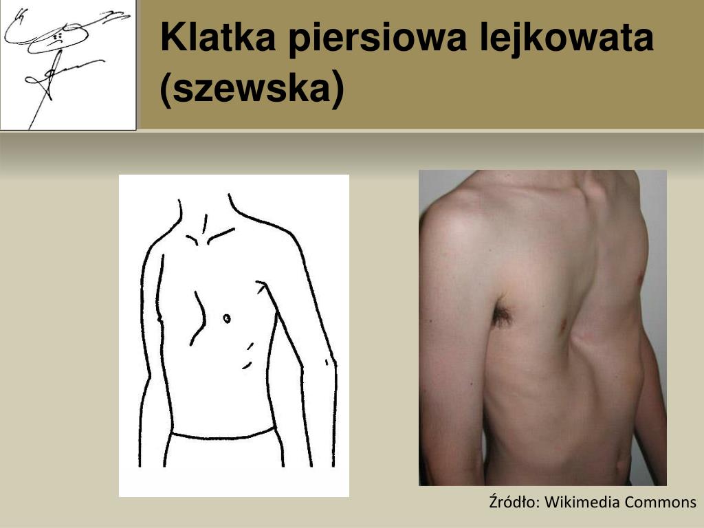 PPT - ĆWICZENIA KOREKCYJNO- -KOMPENSACYJNE PowerPoint Presentation, free  download - ID:4543274