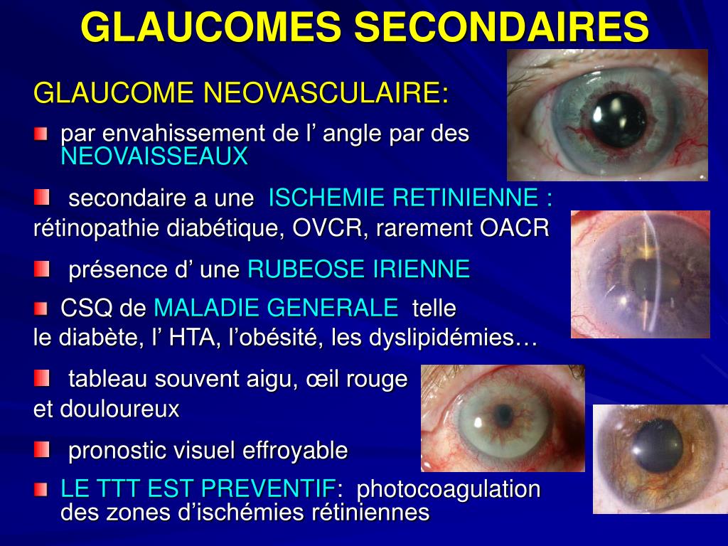 PPT - LES GLAUCOMES PowerPoint Presentation, free download - ID ...