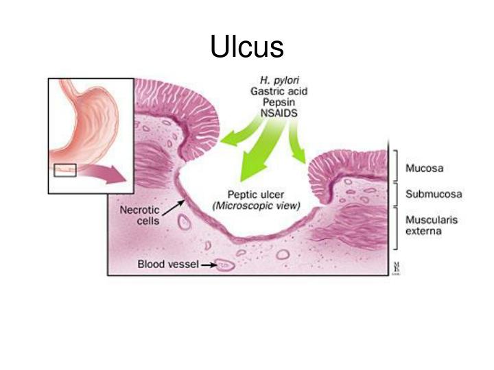 Ulcus Rodems PPT - Handläggning av övre gastroproblem i öppen vård PowerPoint ...