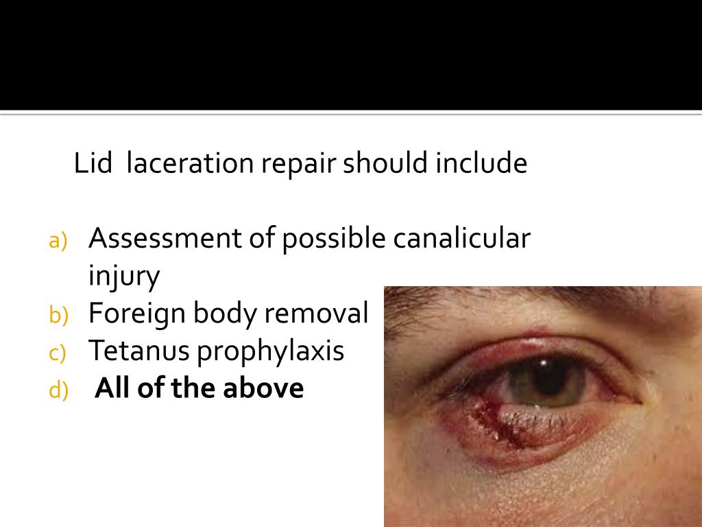 PPT Ophthalmology Review For Year 4 Med Students PowerPoint PPT Ophthalmology Review For Year 4 Med Students PowerPoint