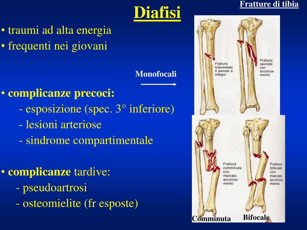 PPT - Fratture dell'arto inferiore PowerPoint Presentation, free download -  ID:4562329