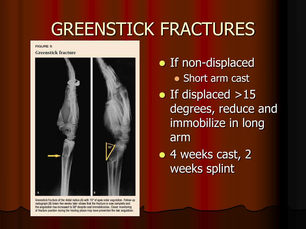 PPT Common Pediatric Fractures PowerPoint Presentation Free Download 