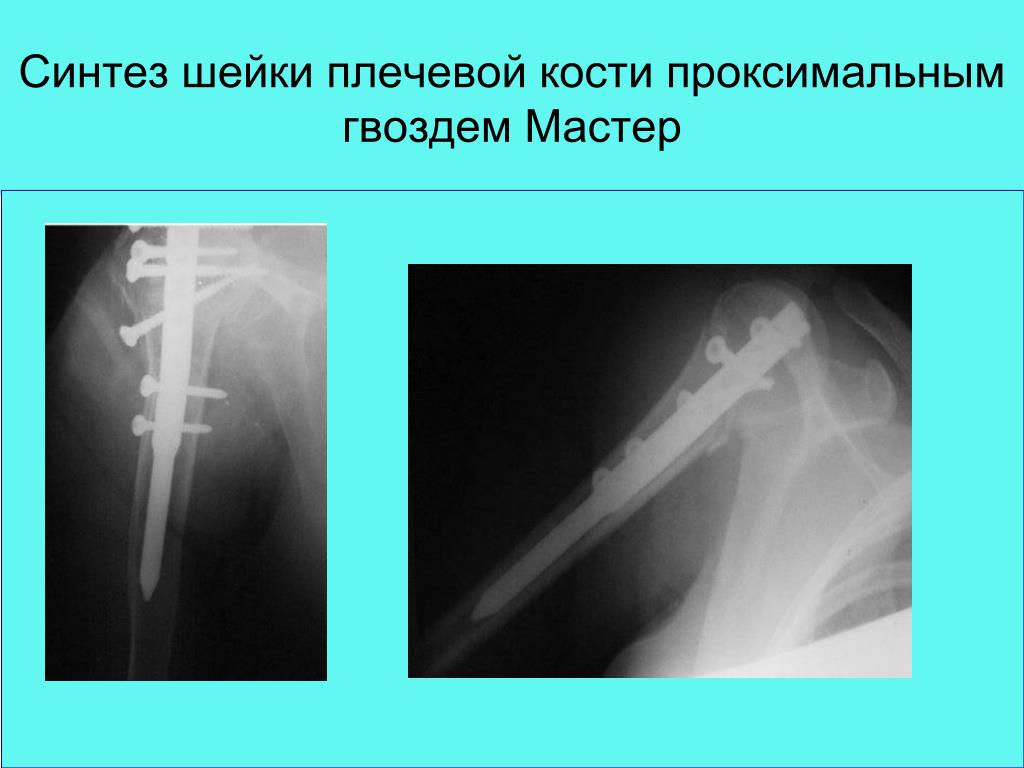 Осложнения остеосинтеза. Перелом шейки плечевой кости рентген. Костный остеосинтез плечевой кости. Перелом хирургической шейки плечевой кости рентген. Перелом анатомической шейки плечевой кости рентген.