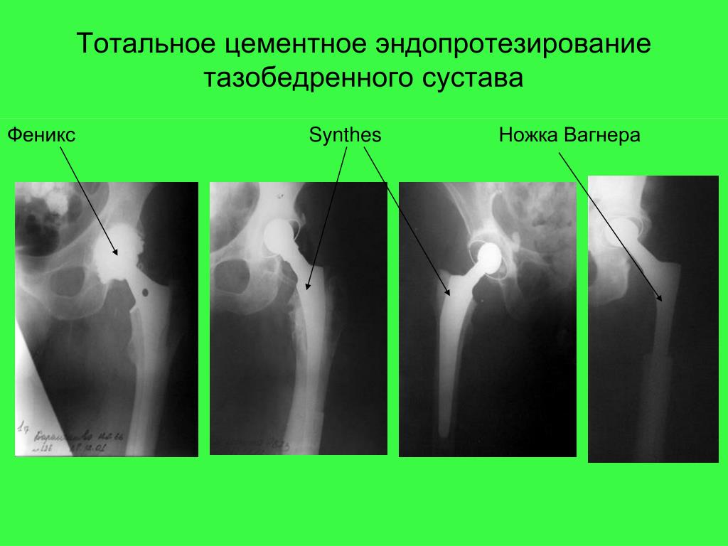 Купить Эндопротез Тазобедренного Сустава Цена