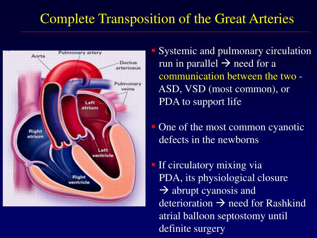 transposition of the great arteries presentation