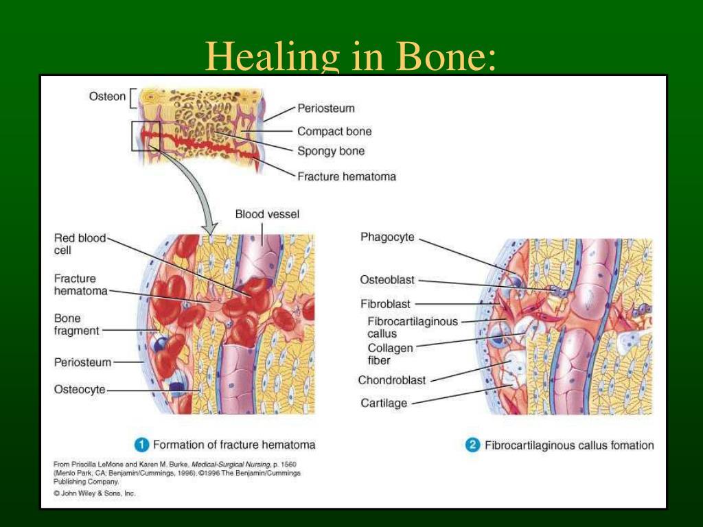 PPT - Bone Histology & Fracture Healing PowerPoint Presentation, free